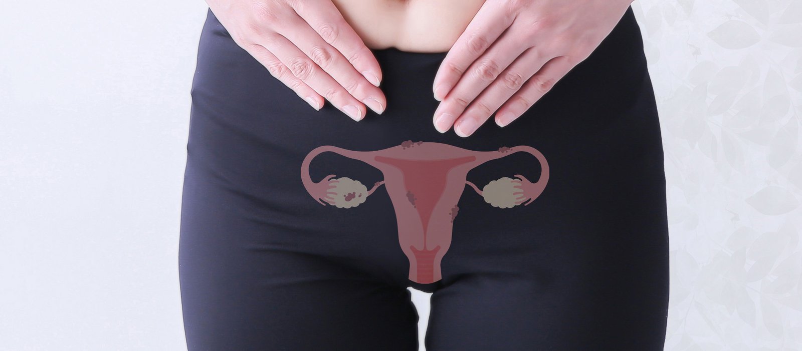 Endometriose: o que é? Saiba mais sobre a doença